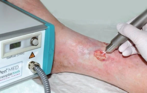 Plasma là gì: Sự Hiểu Biết Sâu Sắc về Công Nghệ Cắt Plasma trong Gia Công Cơ Khí 2 Tia Plasma trong y tế